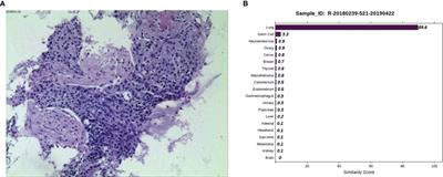 Case Report: Tissue Origin Identification for Cancer of Unknown Primary: Gene Expression Profiling Approach